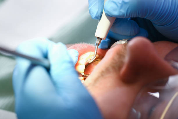 Best Emergency Dentist for Knocked-Out Tooth in Lusk, WY