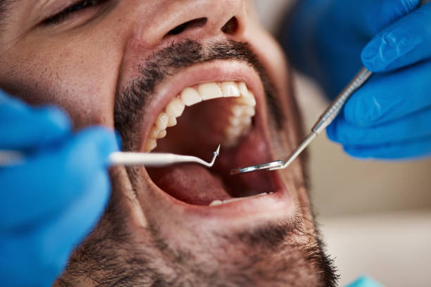 Best Emergency Dentist for Lost Fillings or Crowns in Lusk, WY